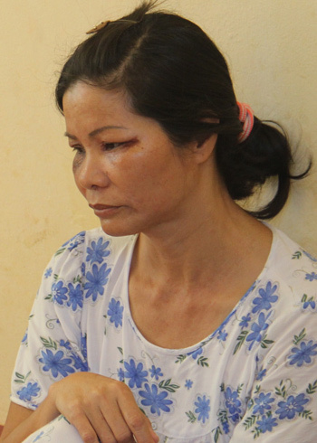 Bà Nguyễn Thị Tý bị kiến khoang đốt sưng mặt. Ảnh: Đăng Nguyên.